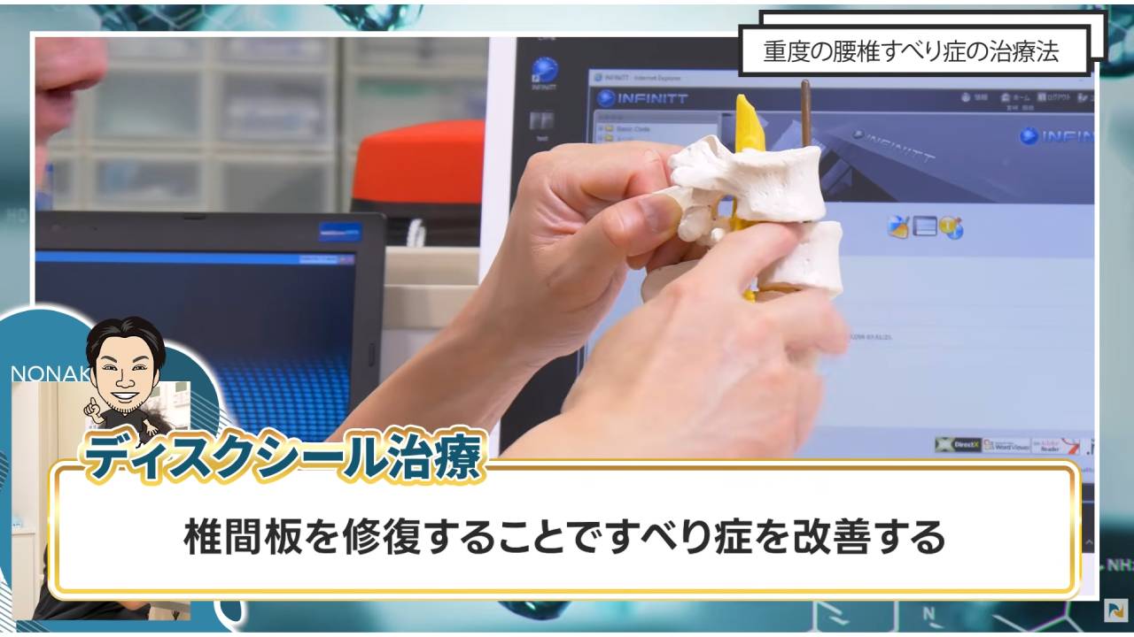 画像はディスクシール治療の説明