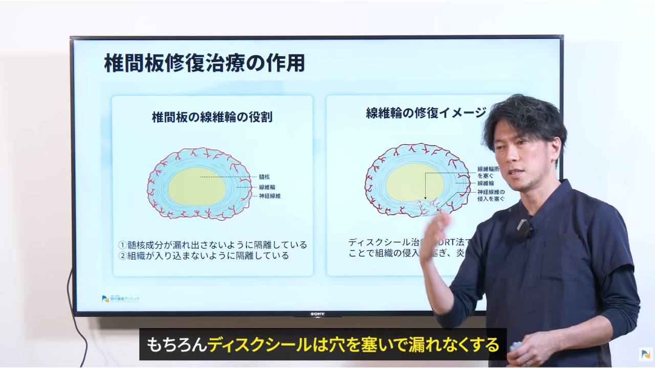 画像はディスクシール治療の説明