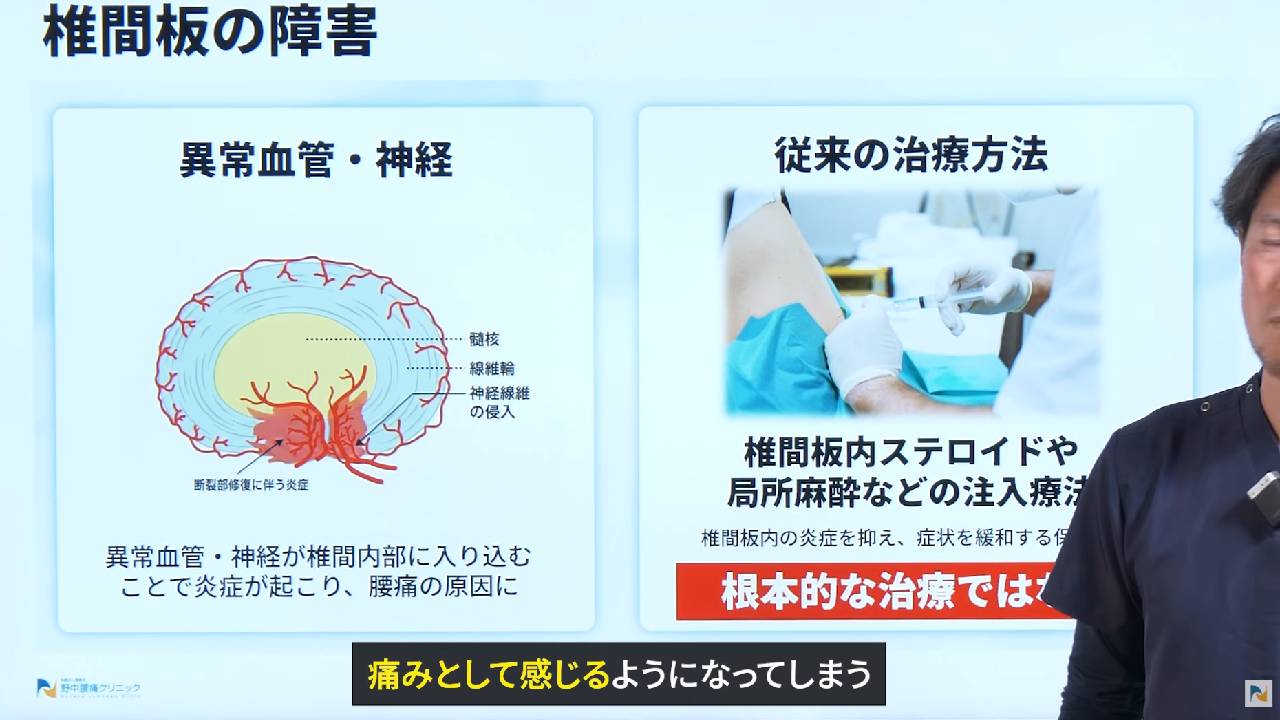 画像は椎間板の変化の説明