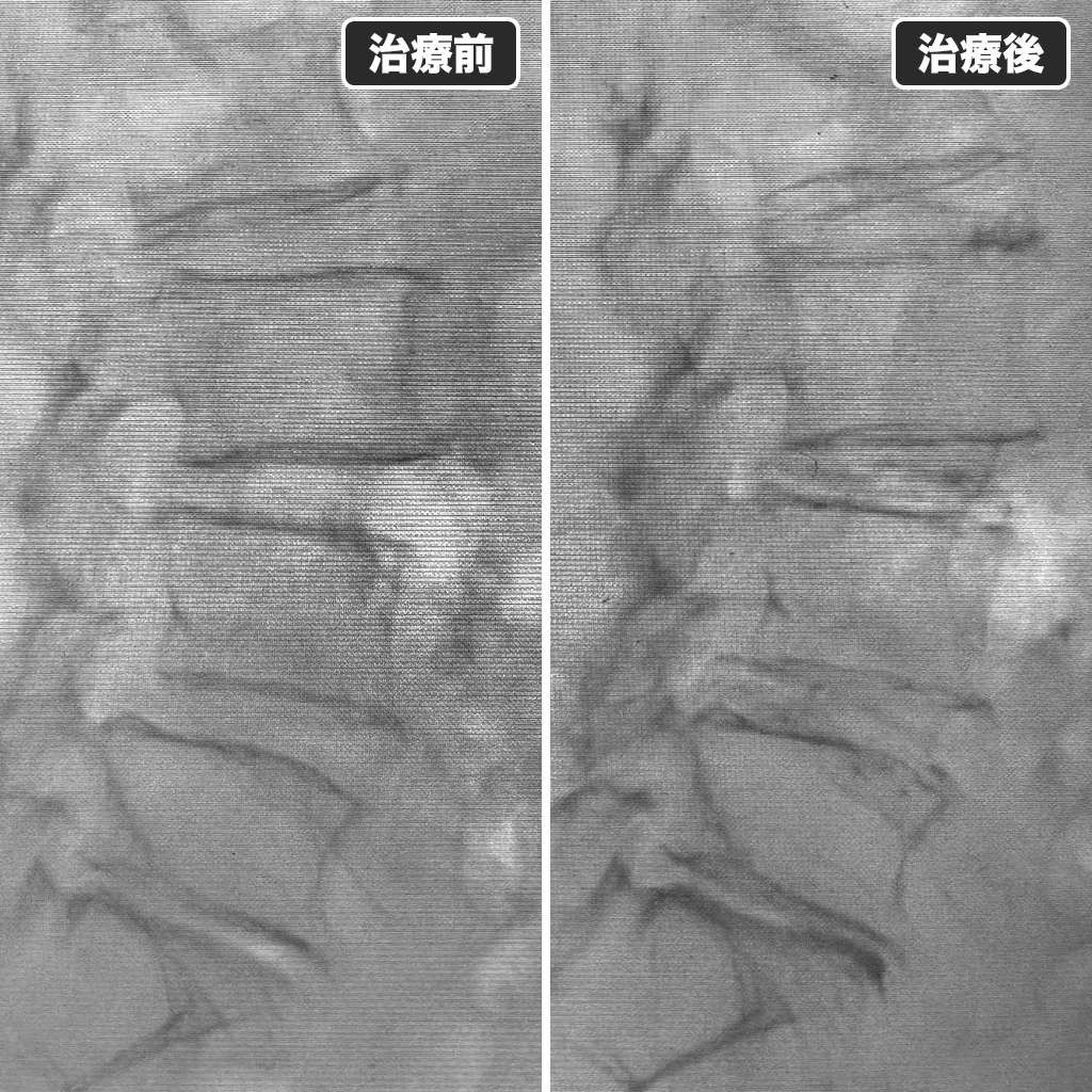 治療前後のレントゲン