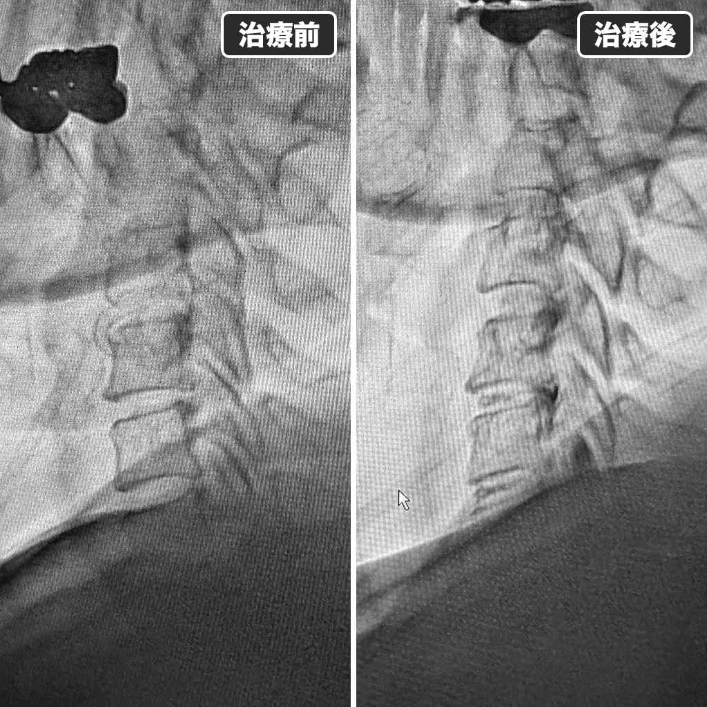 治療前後のレントゲン写真