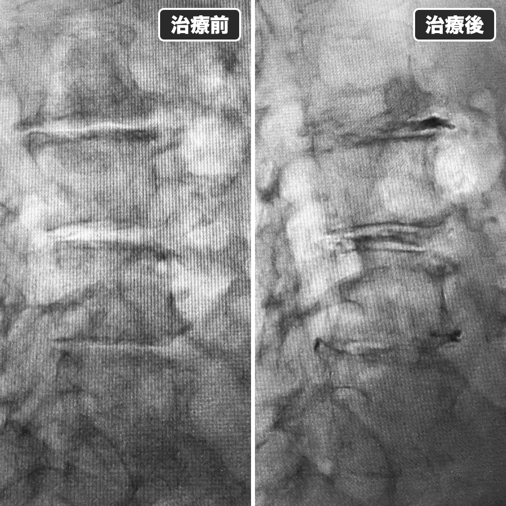 治療前後のレントゲン