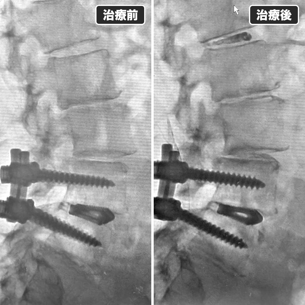 治療前後のレントゲン写真