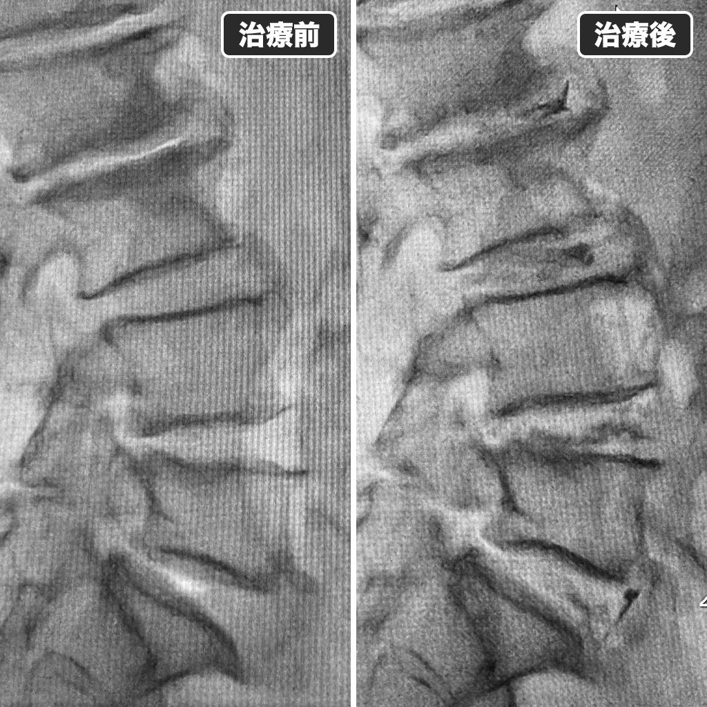 治療前後のレントゲン写真
