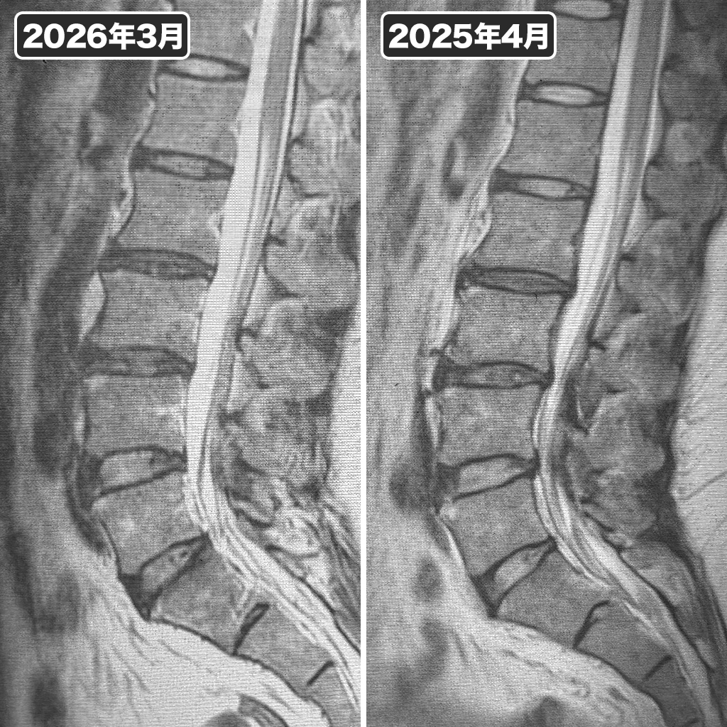 MRI検査（腰椎）