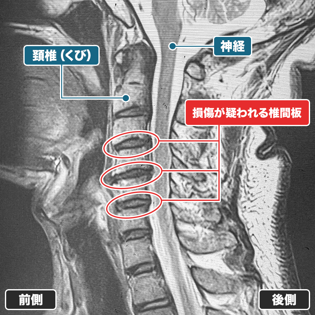 MRI検査（頚椎）