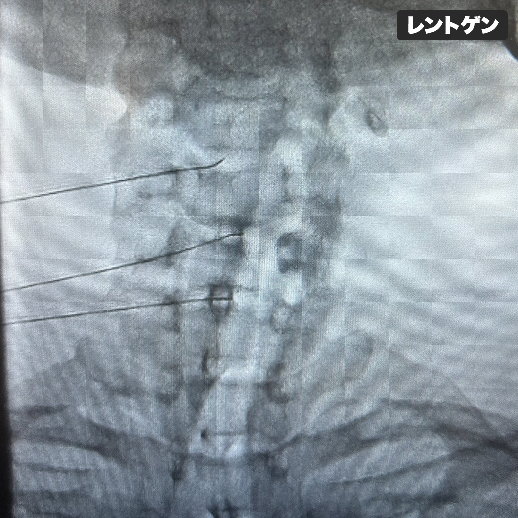 ディスクシール治療