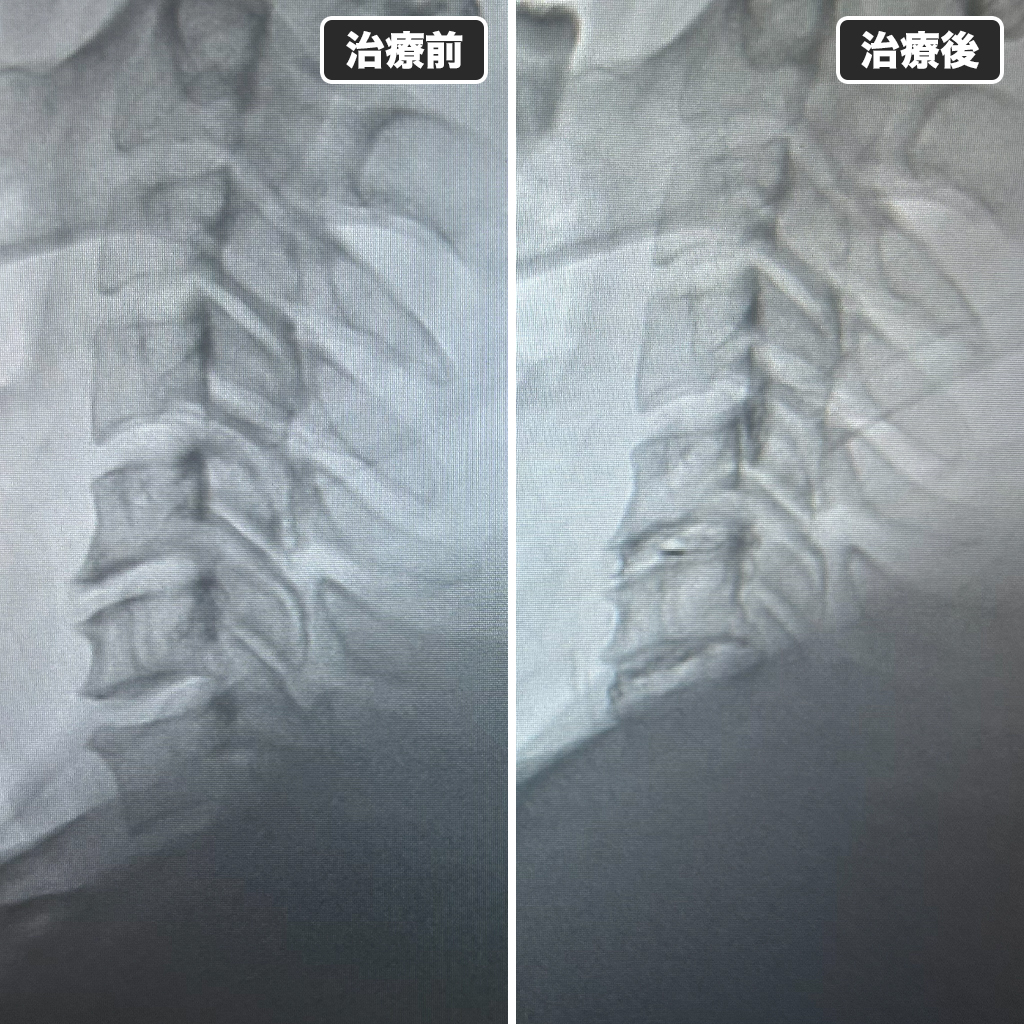 治療前後のレントゲン写真