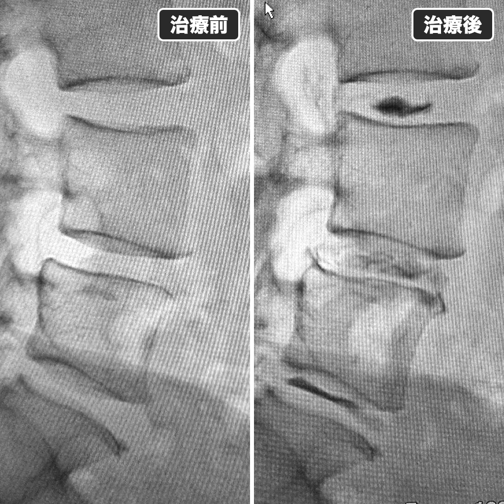 治療前後のレントゲン写真