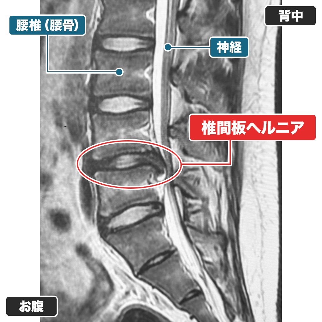 治療前のMRI（側面）