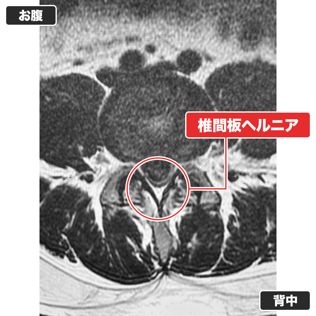治療前のMRI（上面）