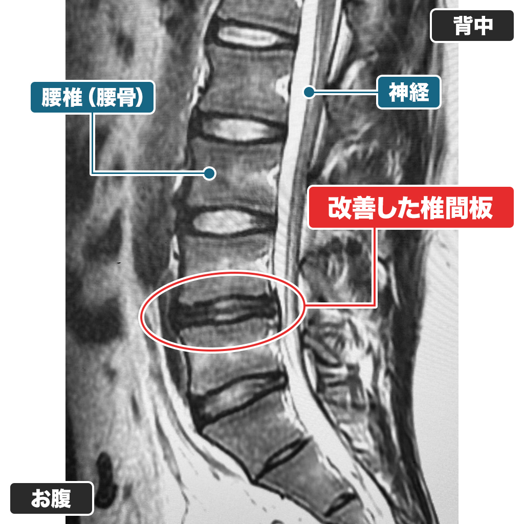 治療後のMRI（側面）