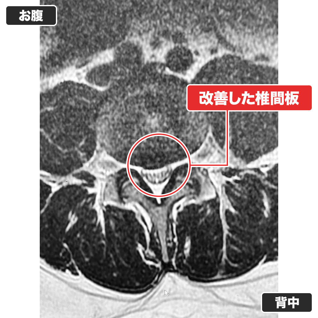 治療後のMRI（上面）