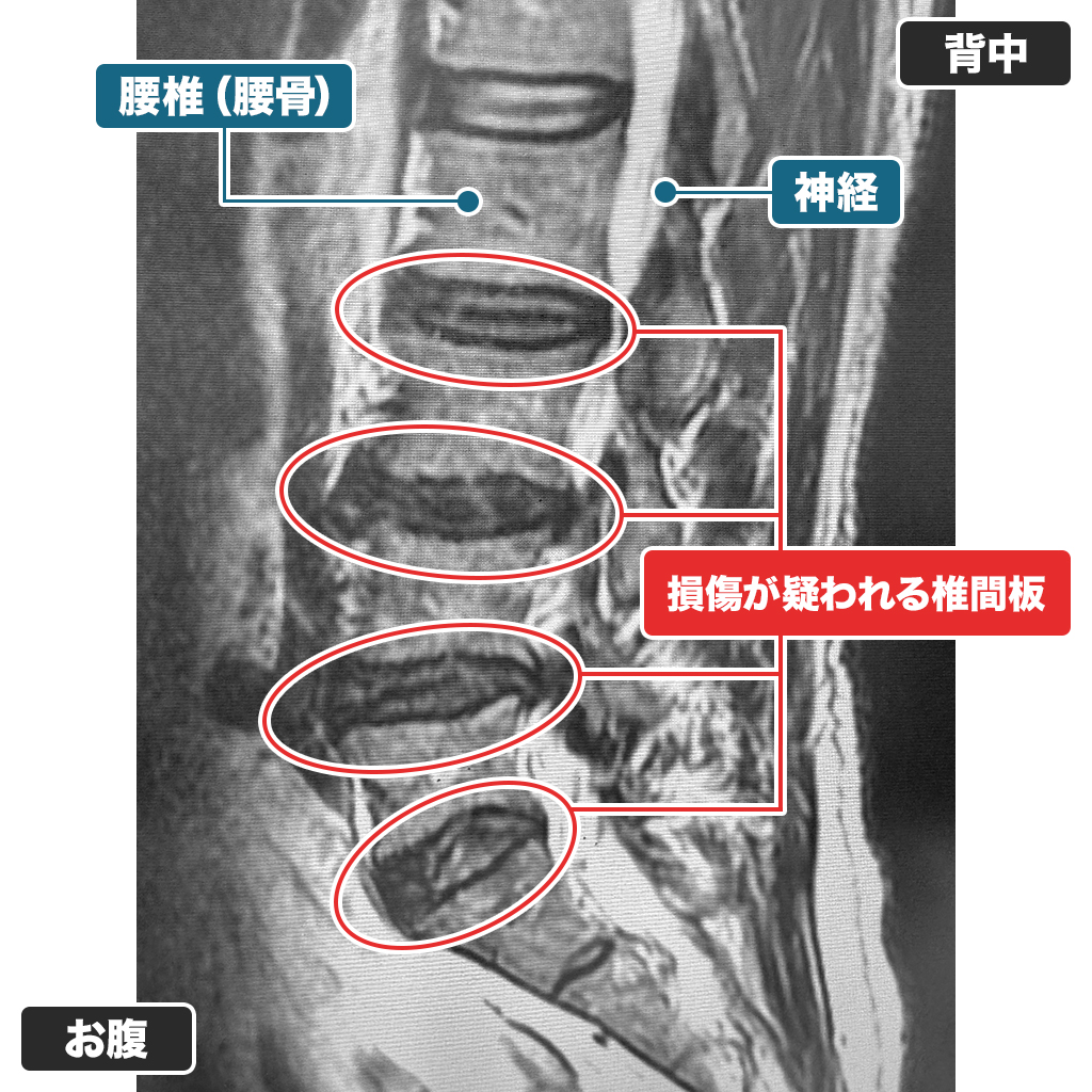 MRI検査