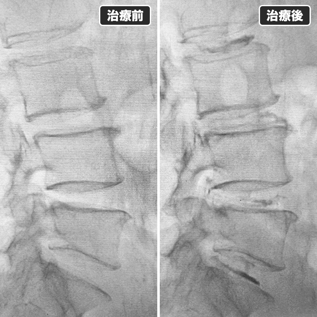 治療前後のレントゲン