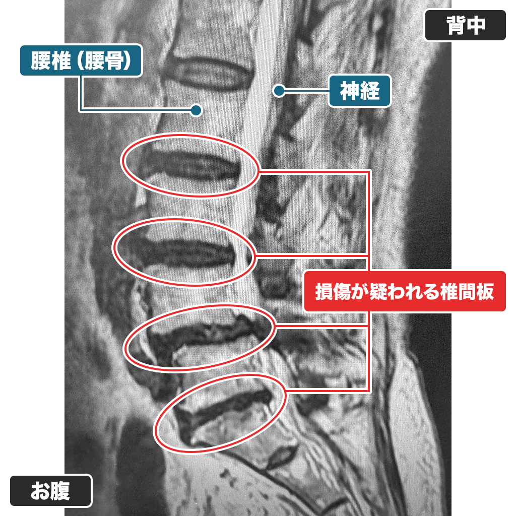 MRI検査