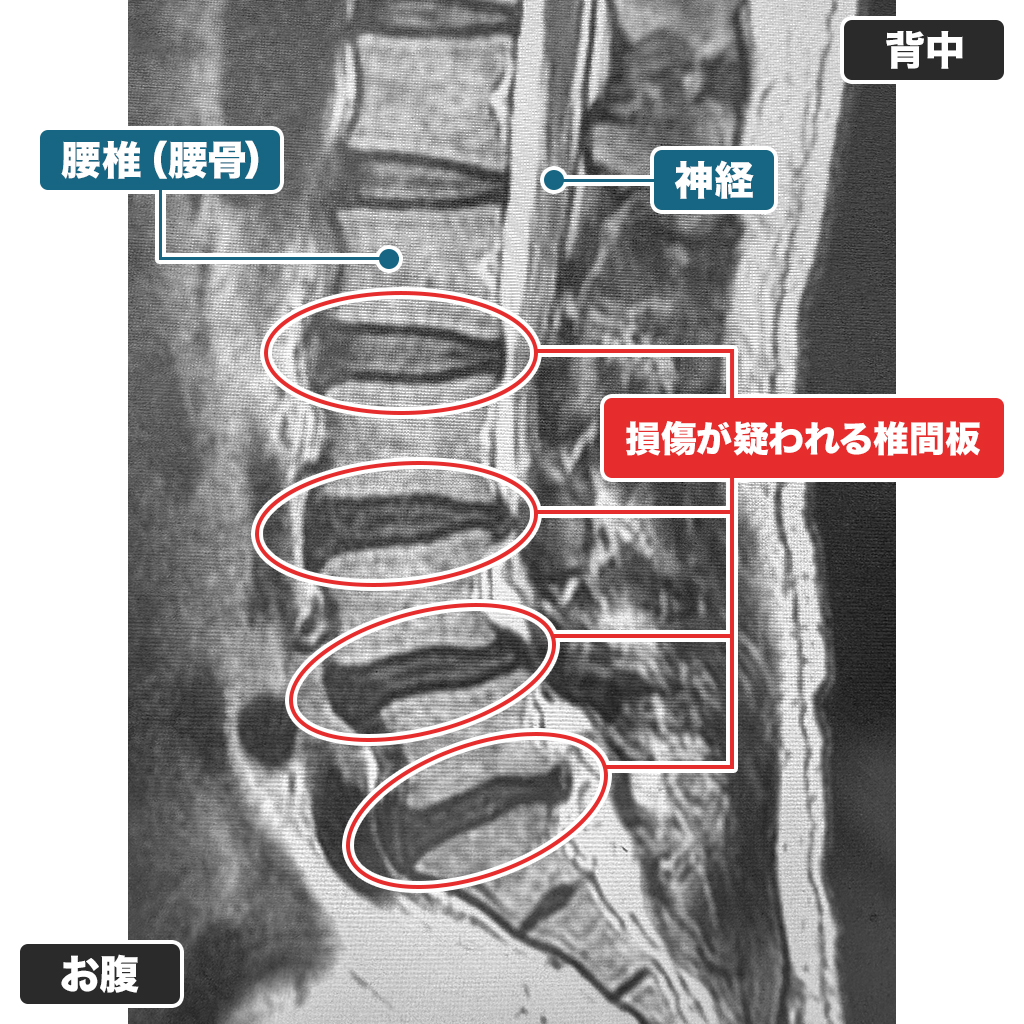 MRI検査