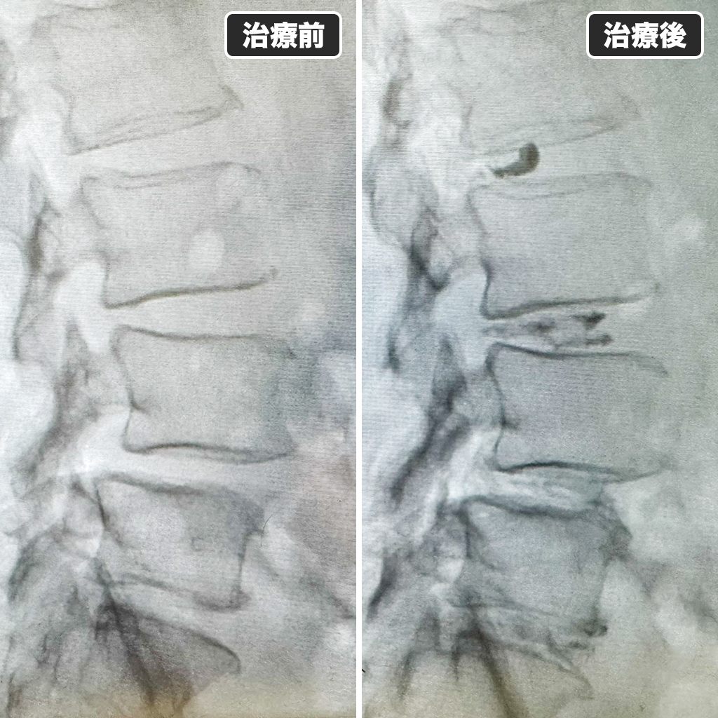 治療前後のレントゲン写真