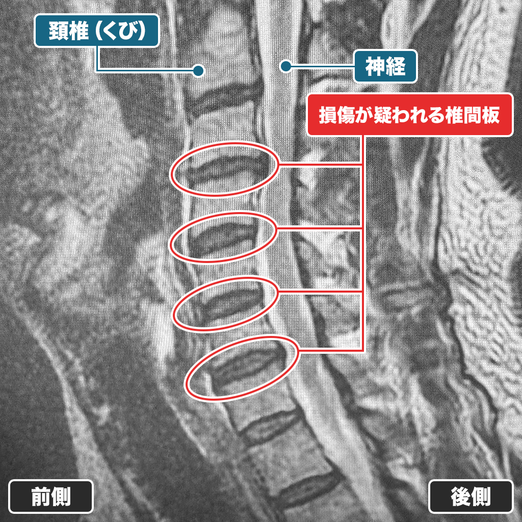 MRI検査