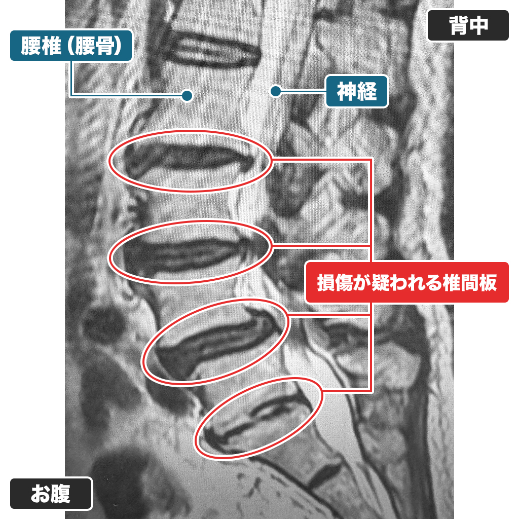 MRI検査