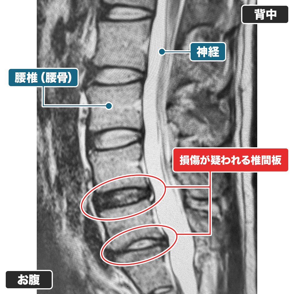 治療前の腰のMRI