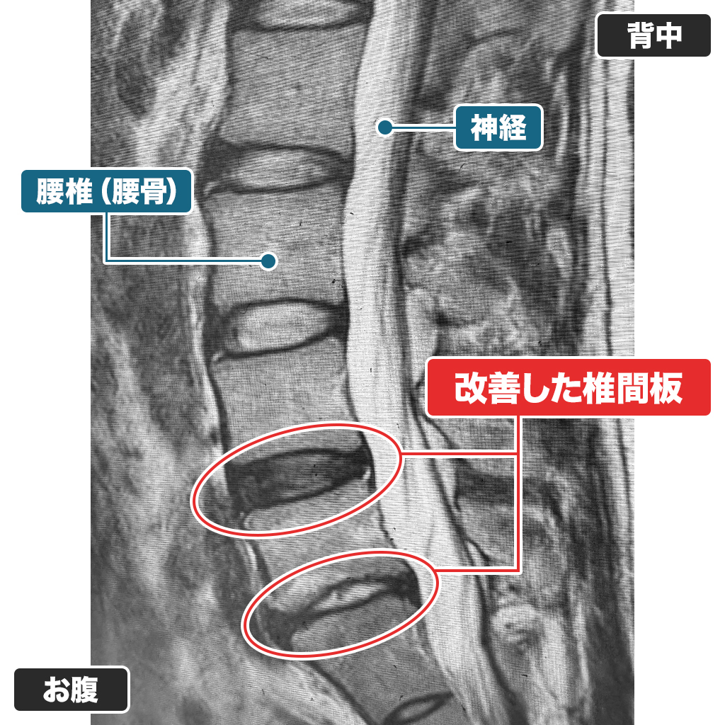 治療後の腰のMRI