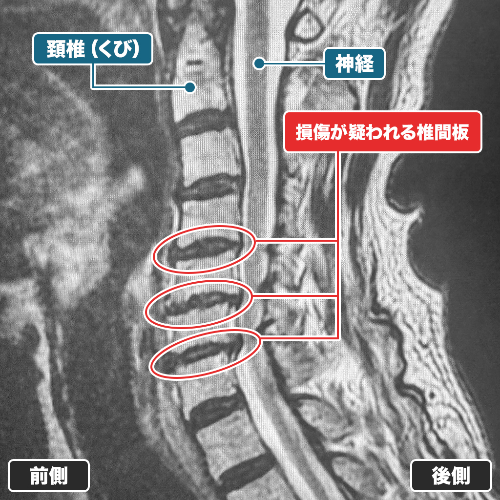 MRI検査