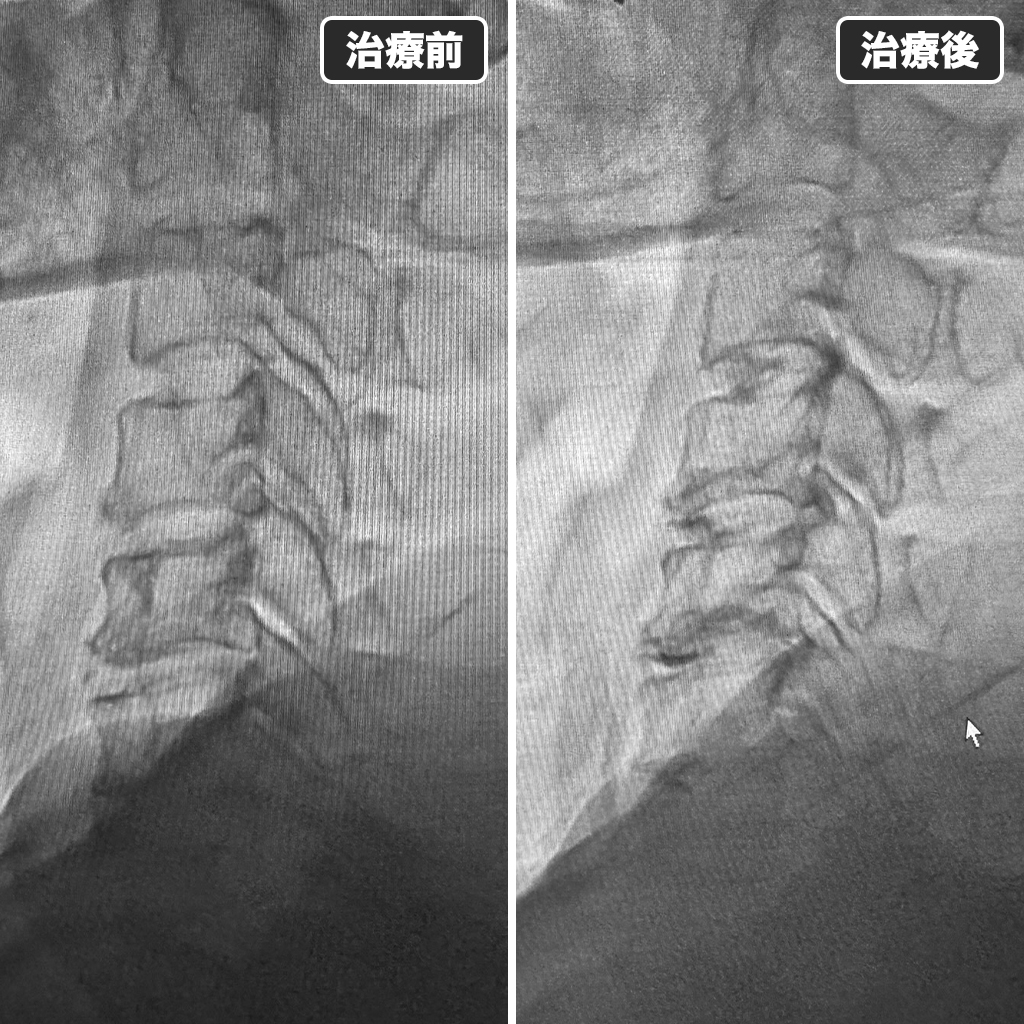 治療前後のレントゲン写真