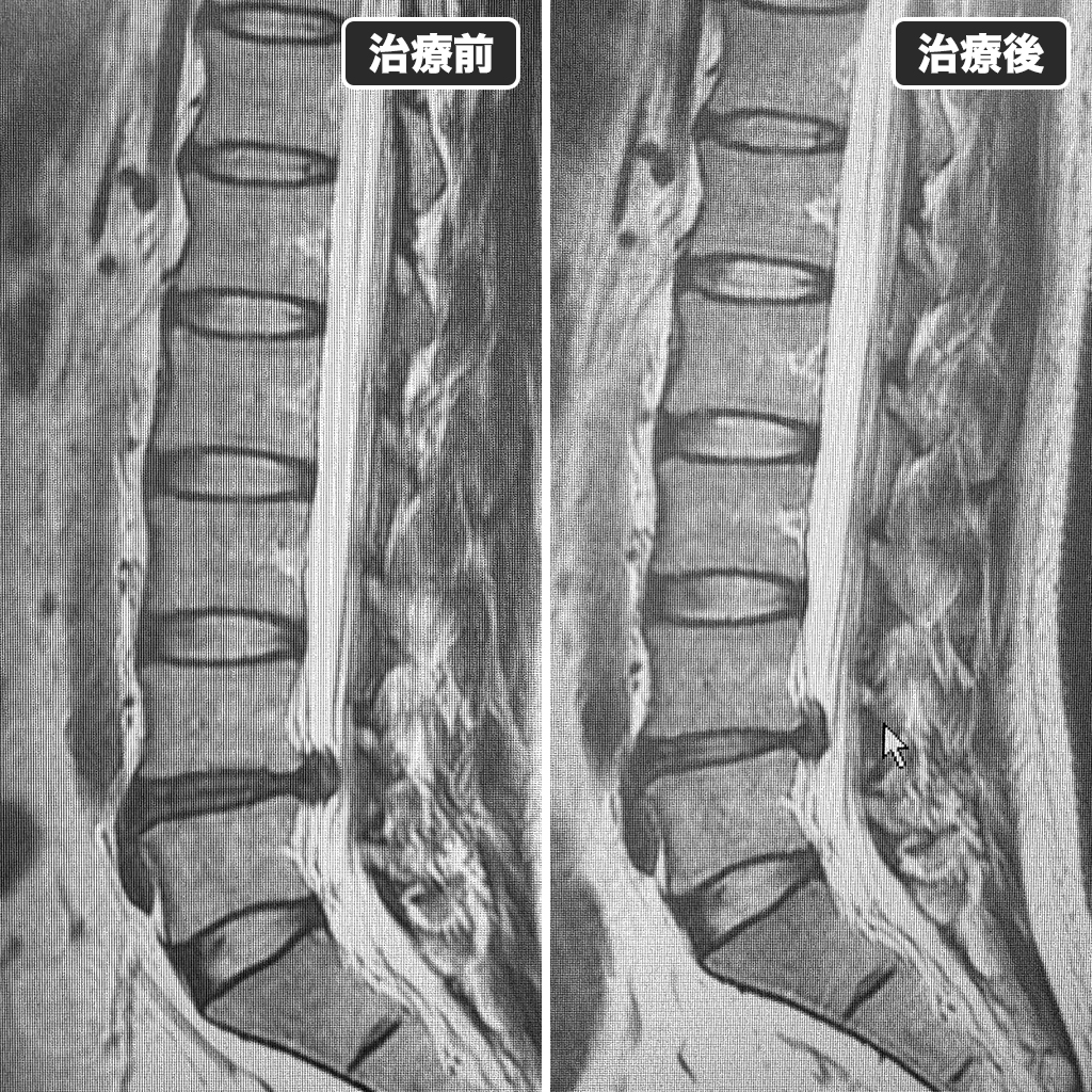 治療前後のMRI
