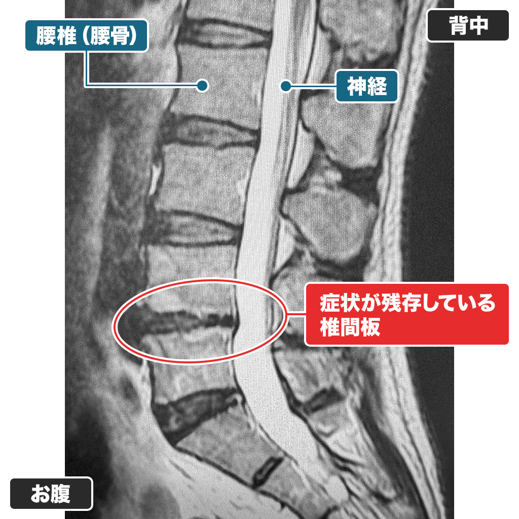 治療前後のMRI