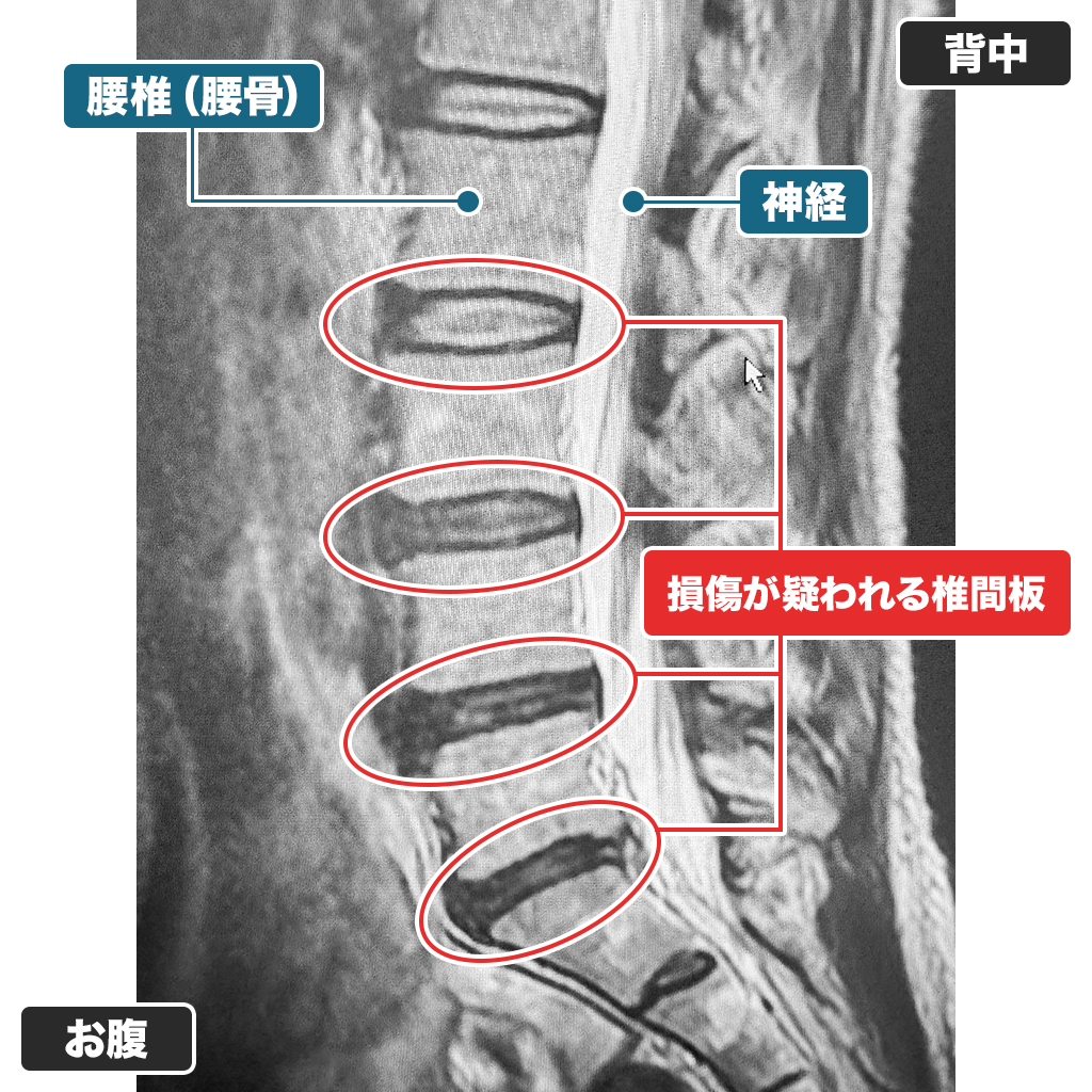 MRI検査