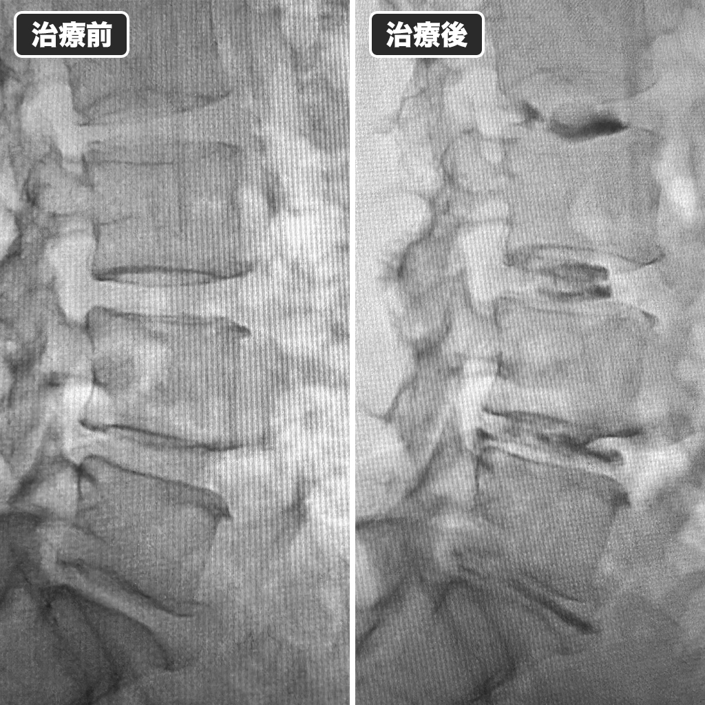 治療前後のレントゲン写真
