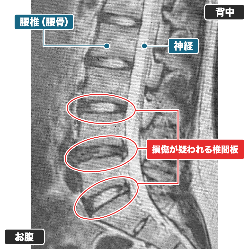 MRI検査