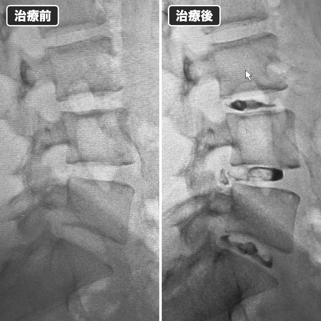 治療前後のレントゲン写真
