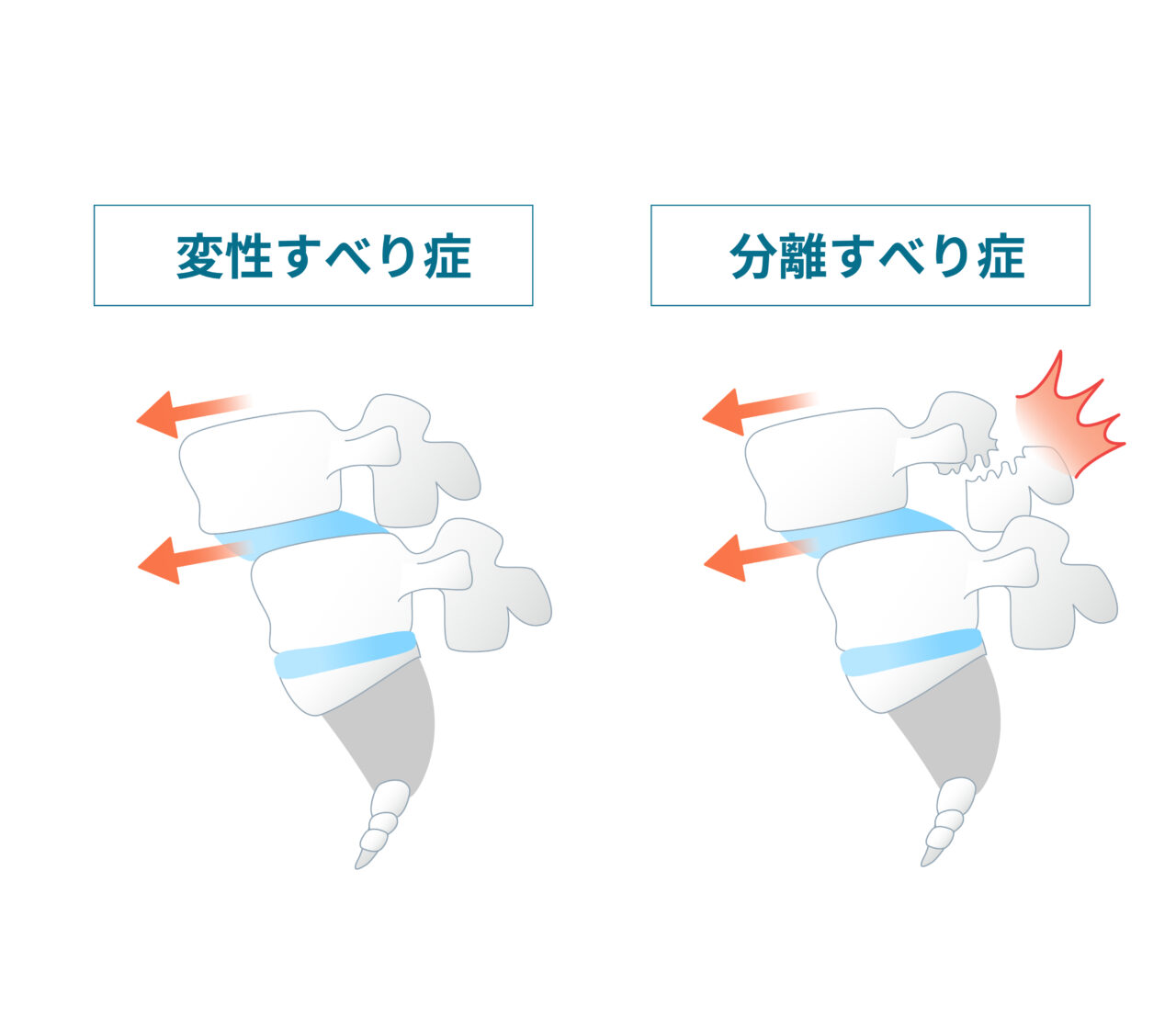 腰椎すべり症