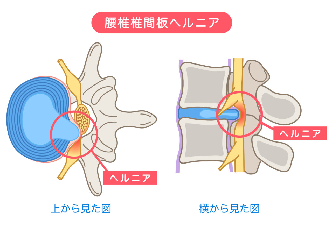 椎間板ヘルニア