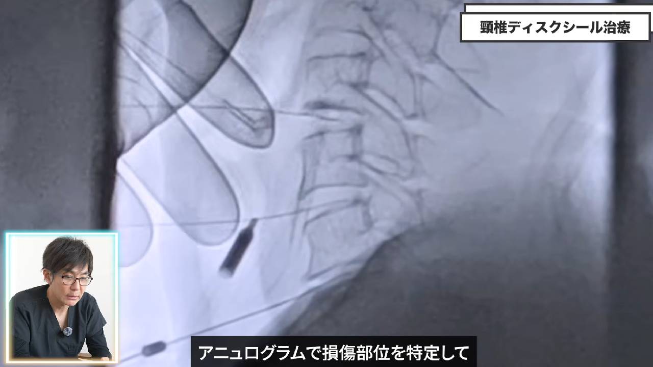 アニュログラム検査