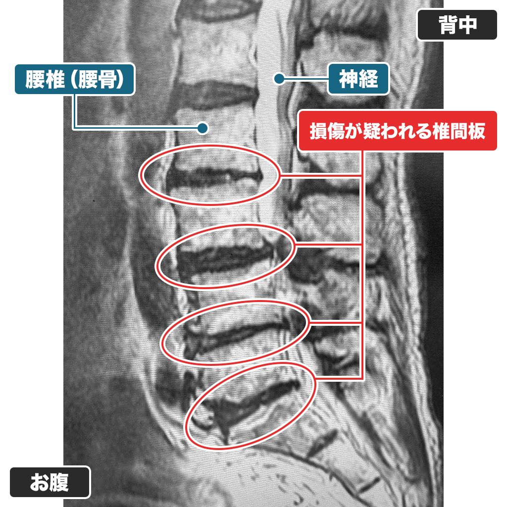 MRI検査