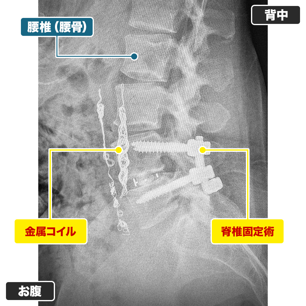 レントゲン検査：側面
