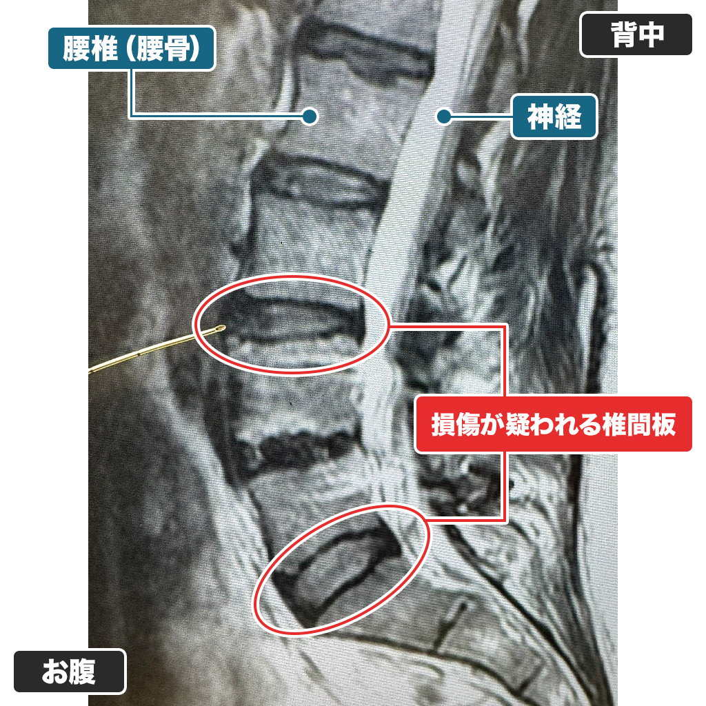 MRI検査