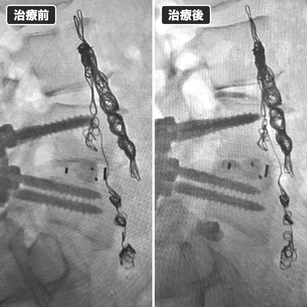 治療前後のレントゲン写真
