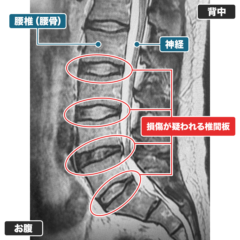 MRI検査