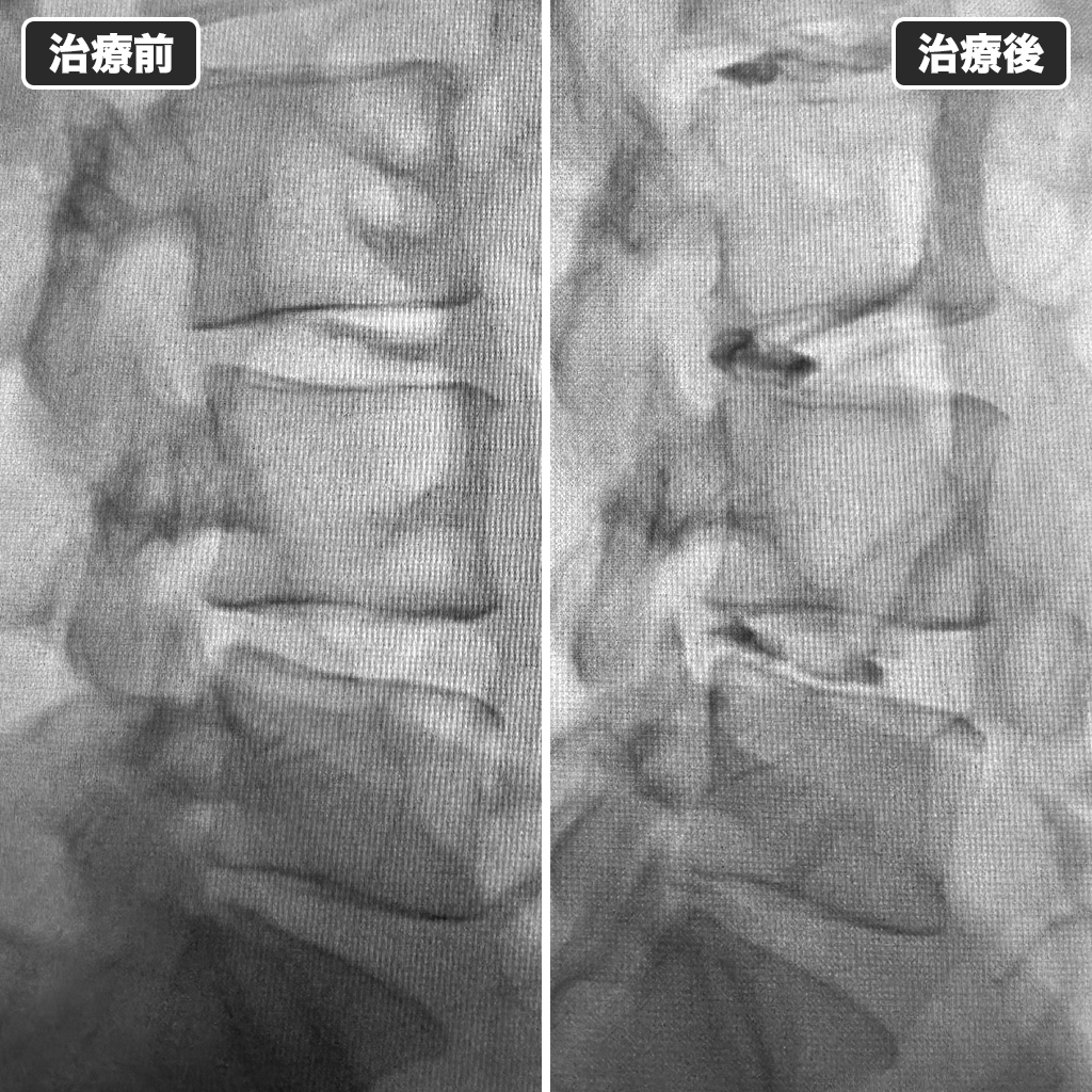 治療前後のレントゲン写真