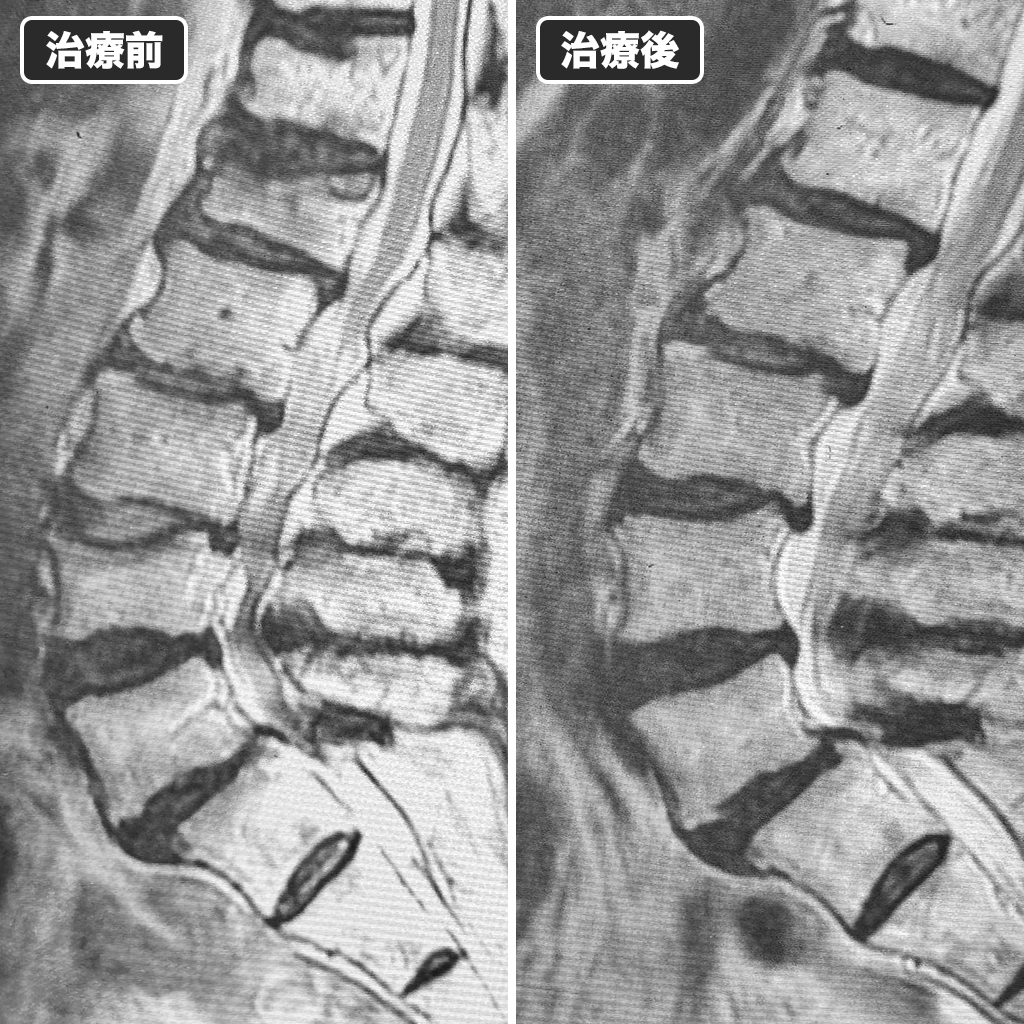 MRI検査