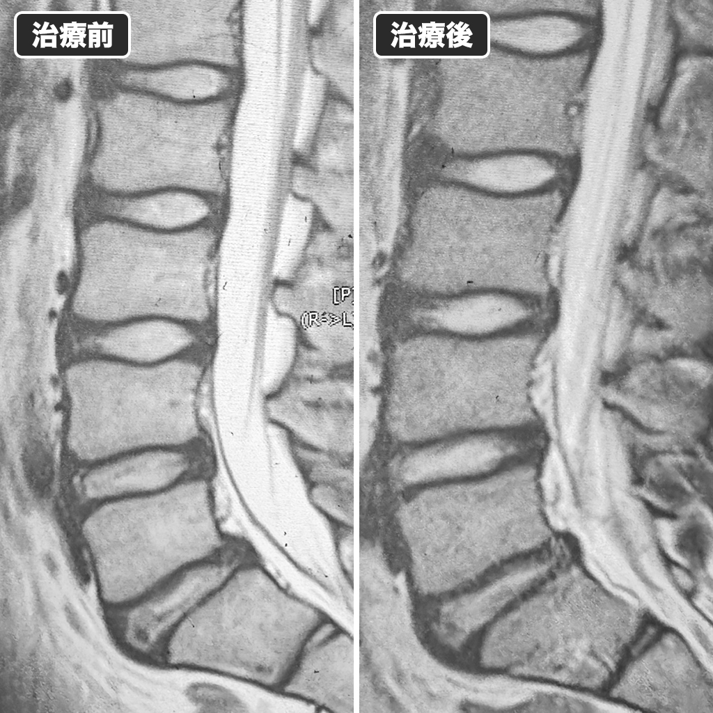 MRI検査