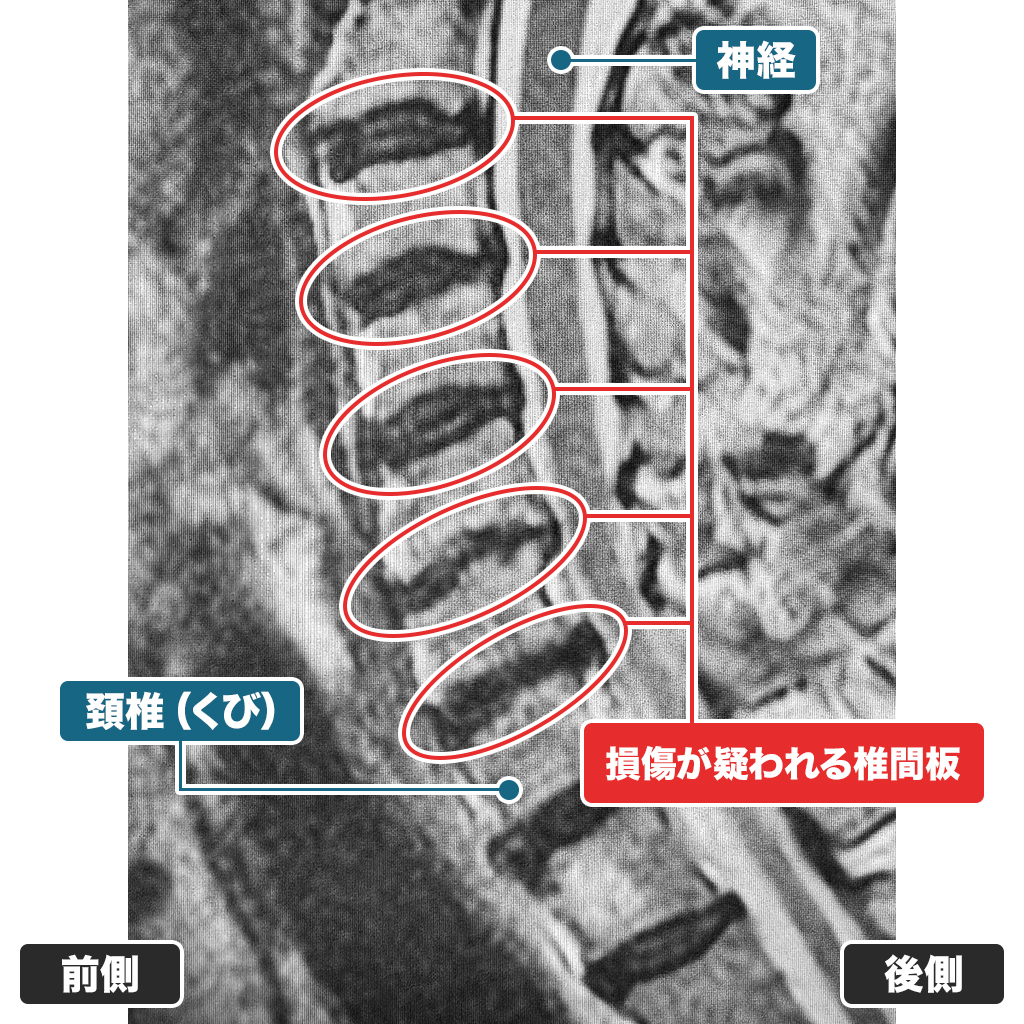 MRI検査