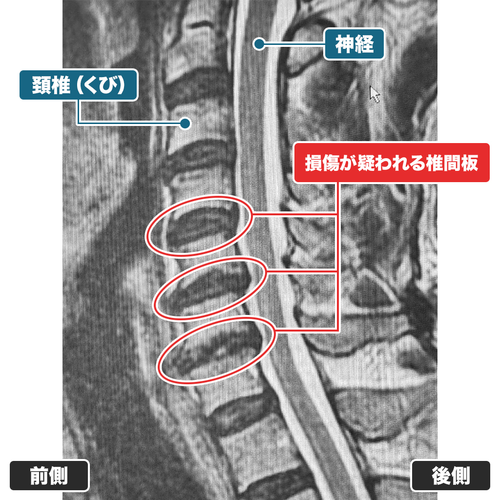 MRI検査