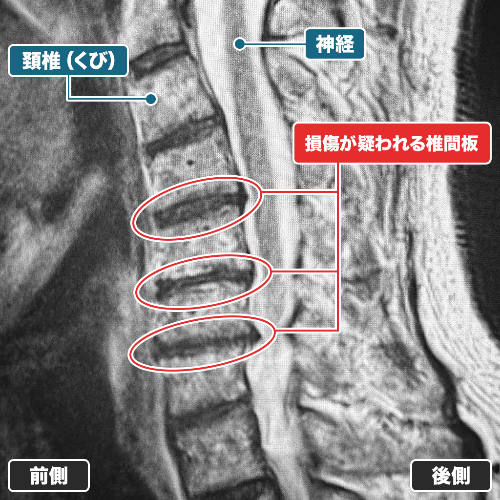 MRI検査