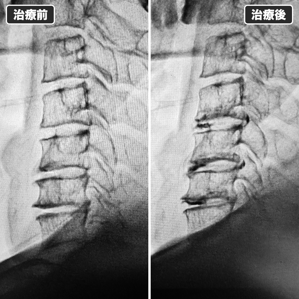 治療前後のレントゲン写真