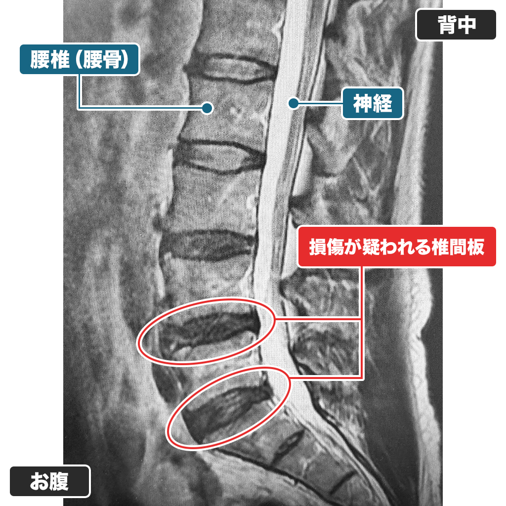 MRI検査